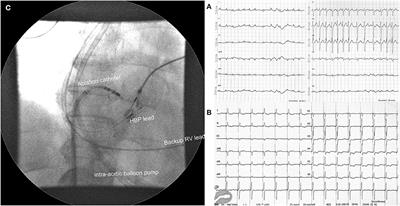 Case report: Treatment of tachycardia-induced cardiogenic shock with permanent His bundle pacing and atrioventricular node ablation